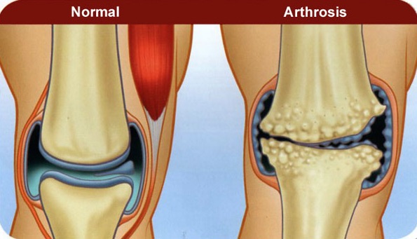 az artrózis 2 kezelésének tünetei