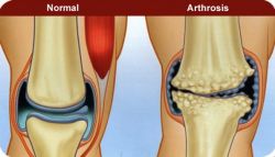 ízületi betegségek artrózis típusok