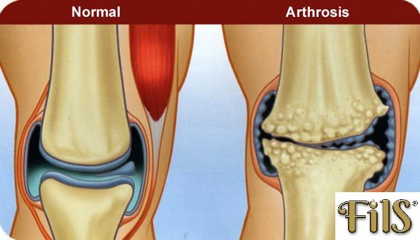 Artrózis kezelése fiatal korban Arthrofoon kezeli az ízületeket és